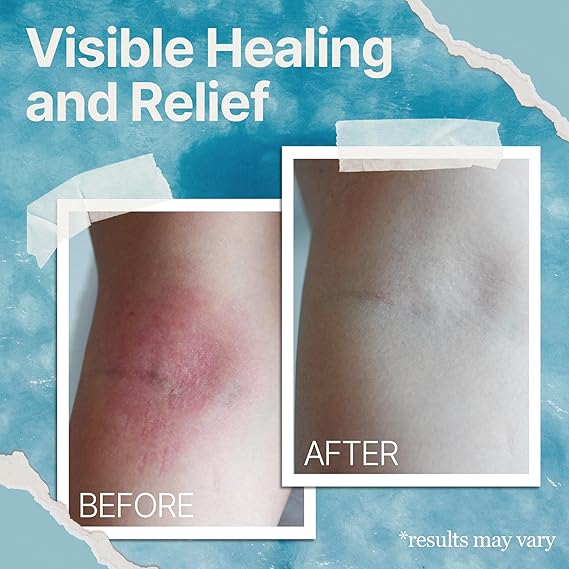 The Ocean Healed My Eczema Natural & Soothing Eczema Cream